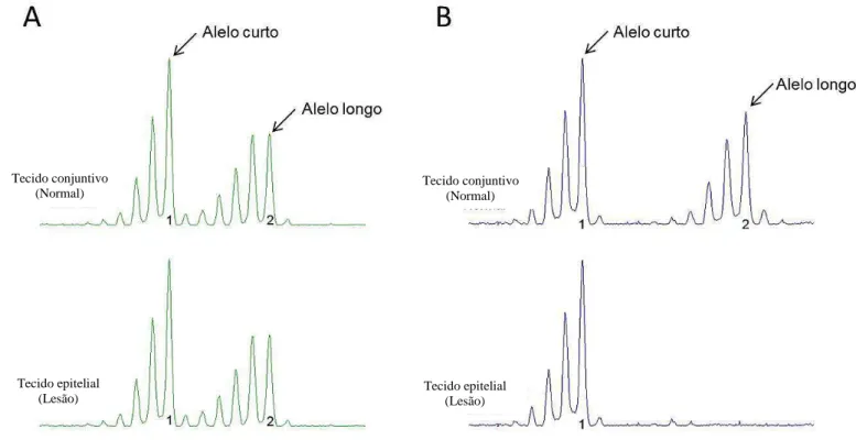 Figura  7:  Eletroferograma  da  análise  de  LOH.  A)  Análise  da  amostra  da  primeira  biópsia  do  paciente  #9  para  o  marcador  D9S157