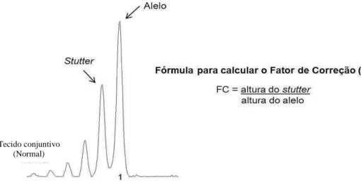 Figura 8: Eletroferograma da primeira biópsia do paciente #12 evidenciando a possível  homozigose da amostra normal para o marcador D11S1883