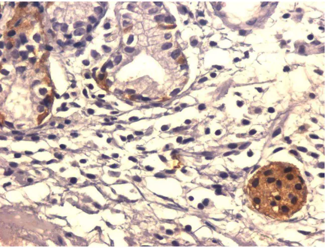 FIGURA 1:   Células imunorreativas à chromogranina-A em paciente com gastrite  atrófica do corpo  em  nódulo hiperplásico com mais de 50% das  células imunomarcadas e na hiperplasia difusa (ihq, aumento 400x) 