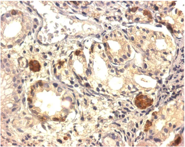 FIGURA 2:   Células imunorreativas à ghrelina em paciente com gastrite atrófica  do  corpo  em  nódulos hiperplásicos com mais de 50% das células  imunomarcadas e na hiperplasia difusa (ihq, aumento 400x) 