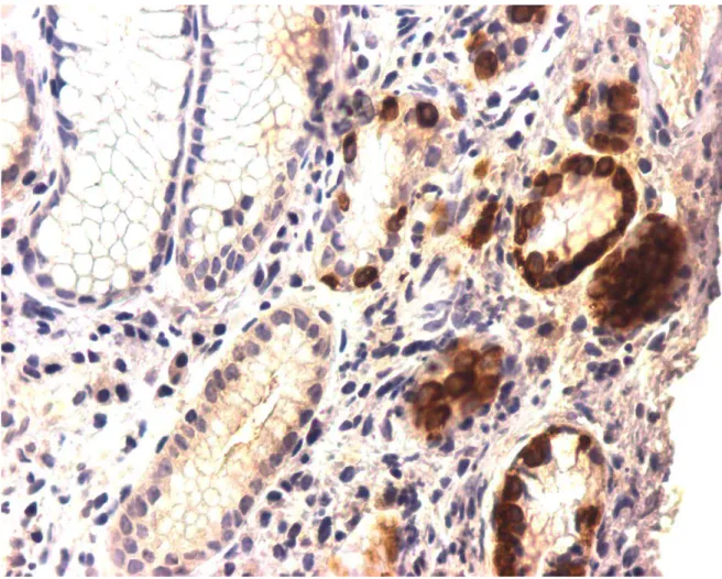 FIGURA 3:   Células imunorreativas à prepro-ghrelina  em paciente com gastrite  atrófica do corpo  em  nódulos hiperplásicos com mais de 50% das  células imunomarcadas e na hiperplasia difusa (ihq, aumento 400x) 