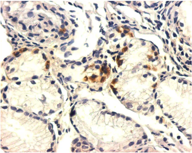 FIGURA 4:   Células imunorreativas à ghrelina em paciente com gastrite atrófica  do corpo em metaplasia pseudoantral (ihq, aumento 400x) 