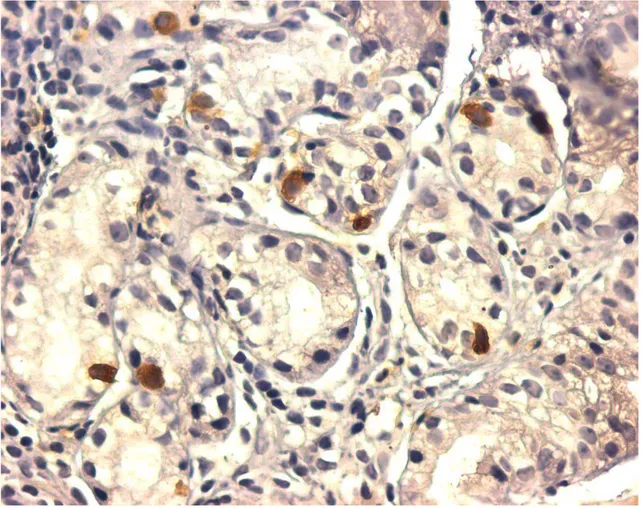 FIGURA 5:   Células imunorreativas à prepro-ghrelina  em paciente com gastrite  atrófica do corpo em metaplasia pseudoantral (ihq, aumento 400x) 