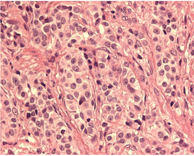 FIGURA 6:   Tumor neuroendócrino tipo I gástrico mostrando células uniformes  sem atipia (HE, aumento de 400x)