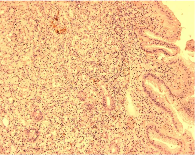 FIGURA 7:   Células imunorreativas à ghrelina em Tumor neuroendócrino tipo I  gástrico mostrando menos de 10% das células imunomarcadas  (ihq, aumento 40x) 