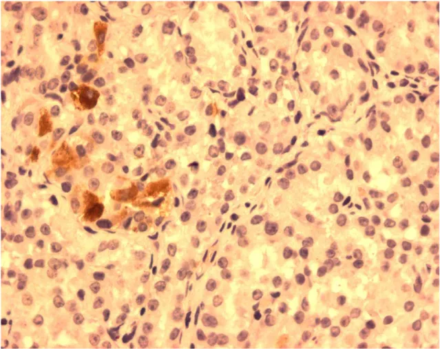 FIGURA 8:   Células imunorreativas à ghrelina em Tumor neuroendócrino tipo I  gástrico mostrando  menos de 10% das células imunomarcadas  (ihq, aumento 400x) 