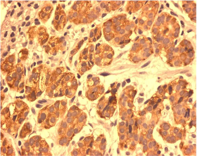 FIGURA 9:   Células imunorreativas à ghrelina em Tumor neuroendócrino tipo I  gástrico mostrando mais de 50% das células imunomarcadas (ihq,  aumento 400x) 