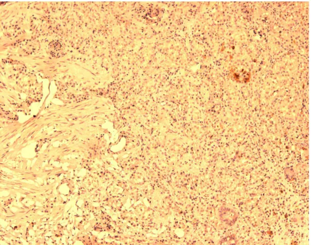 FIGURA 10:   Células imunorreativas à prepro-ghrelina em Tumor neuroendócrino  tipo I gástrico mostrando menos de 10% das células  imunomarcadas (ihq, aumento 40x) 