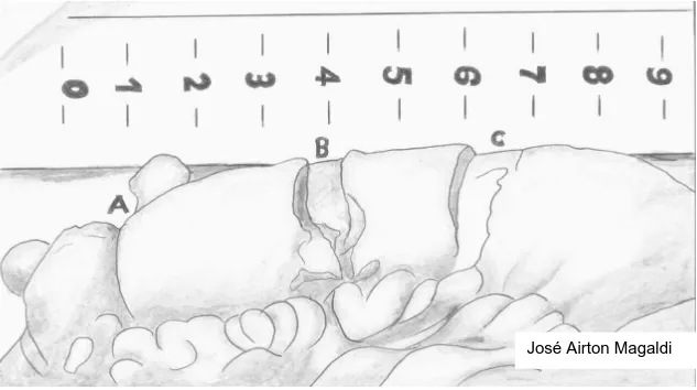 Figura 1 – Desenho esquemático do segmento de intestino humano com  representação de seromiotomias (B e C)