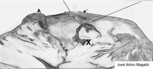Figura 3 - Sutura parcial das seromiotomias (seta)   A: Linha da anastomose íleo-cólica