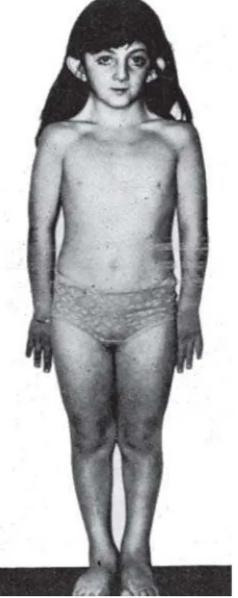 Fig 2: Girl with phenotypical characteristics of Turner’s syndrome (source: http://medidacte.timone.
