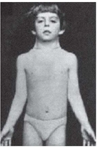 Fig 3:  Child with phenotypical characteristics of Turner’s syndrome, particularly elbow deformities and webbed neck (source: http://