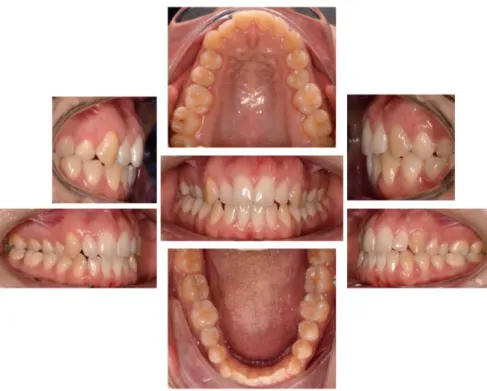 Figura 6. Mordida Cruzada Posterior (cedida por Consulta Assistencial de Ortodontia da Clínica Dentária  Egas Moniz) 