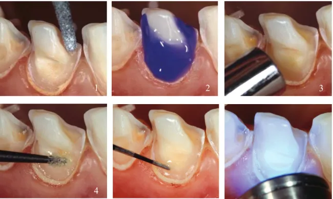 Figura 6 - Immediate Dentin Sealing (Magne, 2005) 
