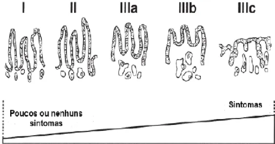 Figura 4 – Espectro da má absorção e sintomas da doença celíaca, Fonte: Adaptada de AGA Institute, 2006