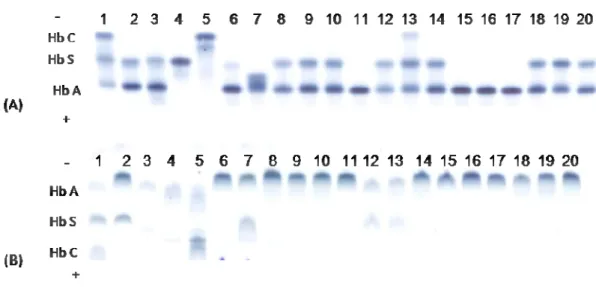 Figura 1- Eletroforeses de hemoglobina em pH alcalino (A) e ácido (B). As amostras de  números  3,  8,  9,  10,  14,  18,  19  e  20  provêm  de  crianças  heterozigotas  para  a  Hb  Stanleyville-II