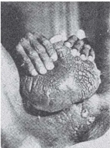 Figure 2: Venereal lymphogranuloma.