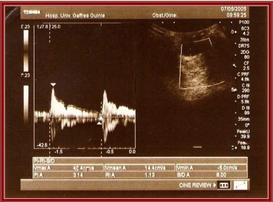 FIGURA 6 - Sonograma de um dos casos da dissertação com índice de  resistência acima de 0,74 (grupo A)