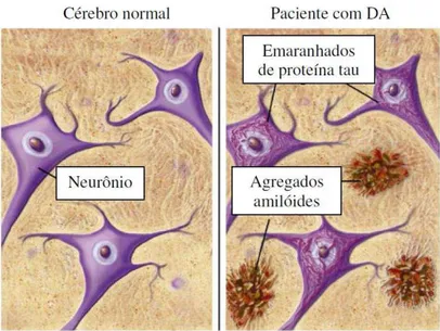 Figura 1.6. Representação esquemática das diferenças entre o cérebro sadio e o cérebro de um                                                   