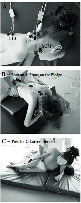 Figure 1  - A) Location of the electrodes for recording activity  of extensor and flexor muscles at the C7 and T10 levels and  the sternocleidomastoid muscle (SCM); B) Representation of  posture 1 recording in the prone position on the wedge; C)  Represent