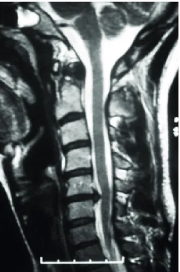 Figure 1  - Case example. Diagnosis of C5-C6 disc herniation  in a sagittal T2-MRI image