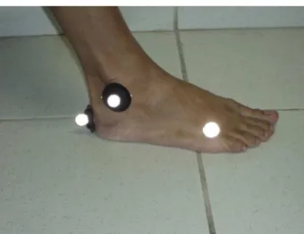 Figure 1  - Assessment of gait speed using markers on the  lower paretic limb.