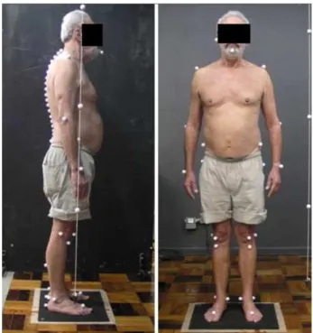 Figure 1  - Evaluation of the postural alignment using PAS.