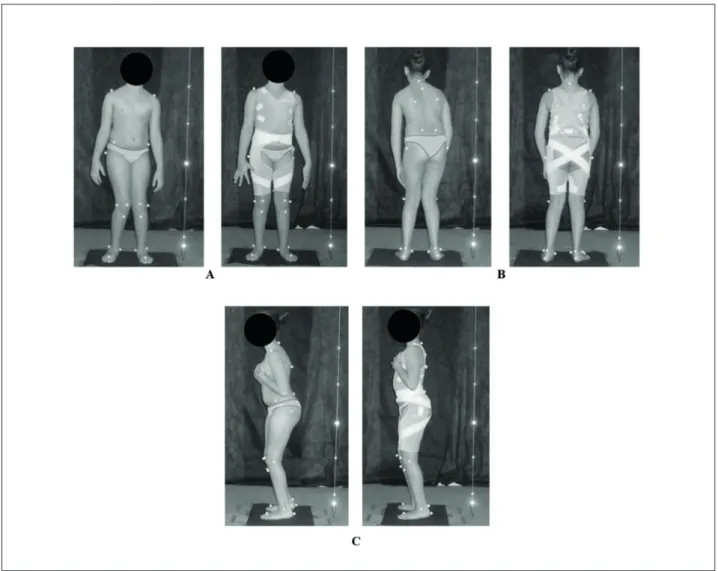 Figure 1  - Child’s posture without TheraTogs ®  and with TheraTogs ® , in front view (A), back view (B) and left side view (C)