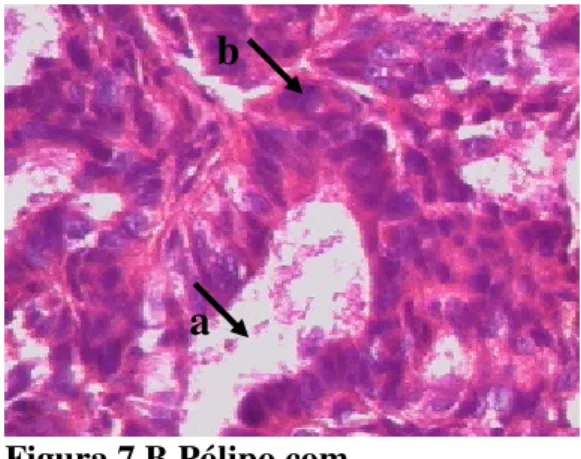 Figura 7.A Pólipo endometrial  hiperplásico. Apresenta glândulas  irregulares (setas) com núcleo 