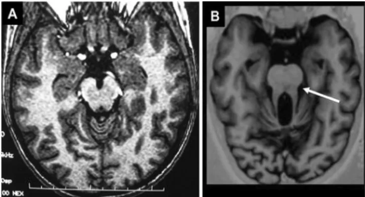 Figura  4- “Sinal  do  dente molar” numa imagem de ressonância  magnética cerebral (RM)