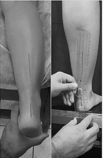 Figure 1. Clinical Test of static posture measurement of subtalar  pronation