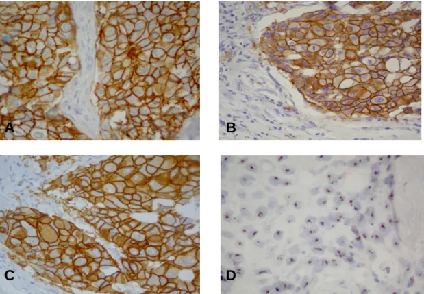 Figure 1. Her2 overexpression and gene amplification in the same case of  invasive breast cancer (X400)