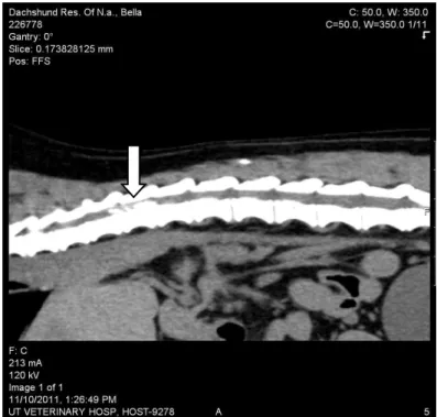 Figura  1  –  Projecção  Sagital  da  Tomografia  Computorizada  Realizada  (seta:  presença  de  material  mineralizado  no  canal  vertebral  em  toda  a  extensão  da  T12)  (imagem  gentilmente  cedida  por  Dra