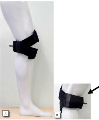 Figure 1: Orthosis for gait rehabilitation. (A) lateral view of the  neoprene strips above and below the patella; (B) greater detail of  the position of the inlatable cuf on the popliteal region (arrow)