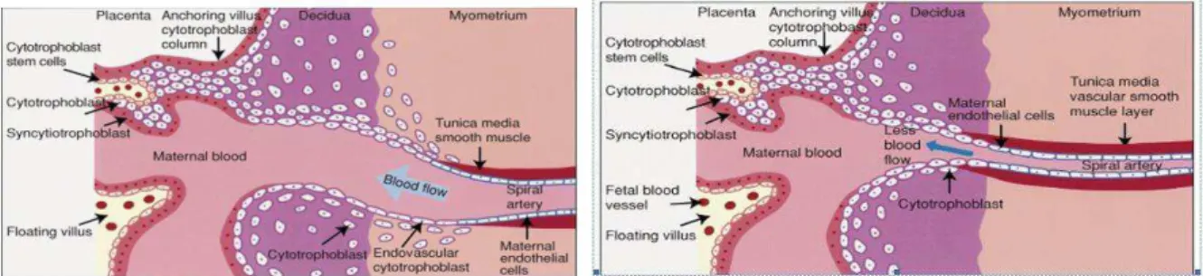 Figura 2: A e B  –Invasão trofoblástica anômala na preeclâmpsia (Karumanchi et al., 2005)