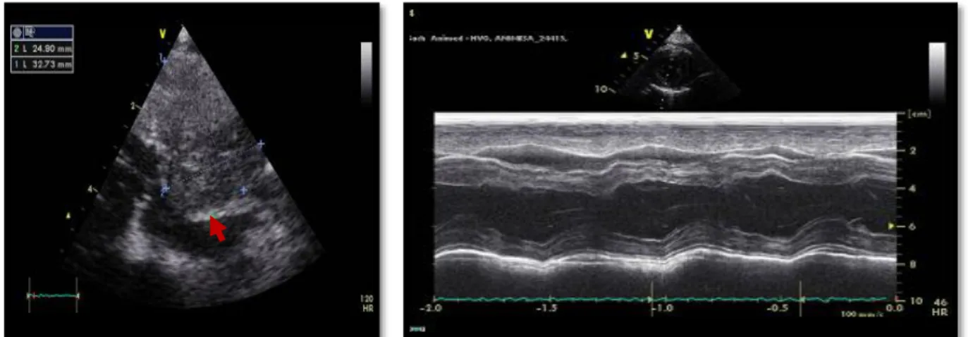 Figura 4: Ecocardiografia em corte paraesternal direito em modo  M  (1ªconsulta  do  Sach):  presença  de  derrame  pericárdico  sem  presença de tamponamento de qualquer câmara cardíaca