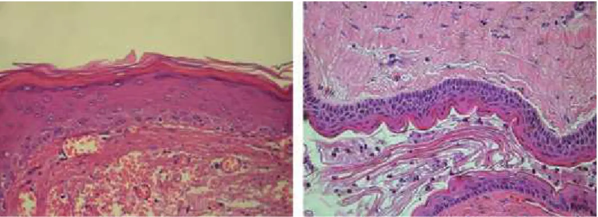 Figure  1  Photomicrograph  of  a  orthokeratinized  odontogenic  cyst  (A)  and  keratocystic  odontogenic tumor (B) included in the study