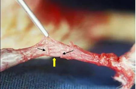 Figura 5  – Secção da seromuscular, com exposição da mucosa (seta fina),  e preservação da arcada (seta grossa)