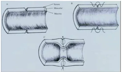 Figura  10  –  Esquema  ilustrativo  das  etapas  do  procedimento  de  confecção  da  seromiotomia  que  dá  origem  às  valvulas
