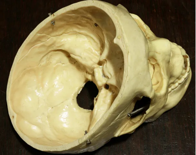 FIGURA 2. Superfície interna do crânio com trajeto do sulco do seio sigmóideo  na fossa posterior à esquerda