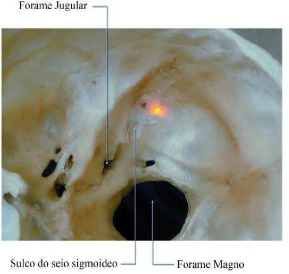 FIGURA 5 -  Transiluminação do crânio com Laser para definição da  correspondência do ponto digástrico na superfície interna do crânio  