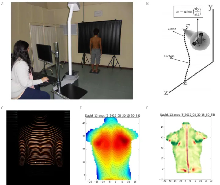 Figure 1. (A) Physical structure of the Vert 3D system and positioning of child to conduct postural evaluation; (B) representation  of symmetry line analysis in sagittal plane to obtain Vert angles for thoracic kyphosis, with dy and dz being the measure in