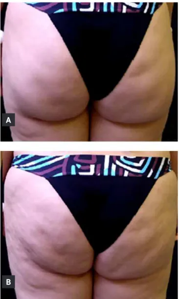 Figure 2. Gluteal region without contraction (A) and with  contraction (B).