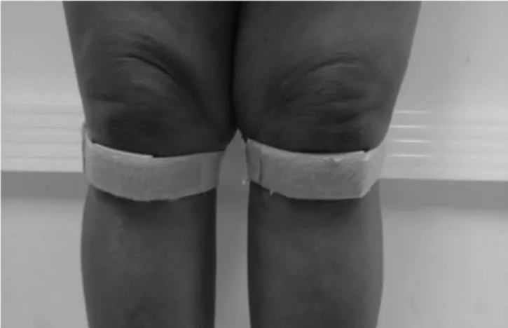 Figure 1. Infrapatellar bandage