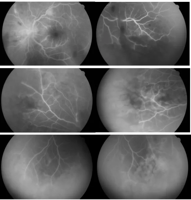 Fig. 2 - Angiografia do olho esquerdo à apresentação, mostrando vasculopatia oclusiva, arterite e papilite