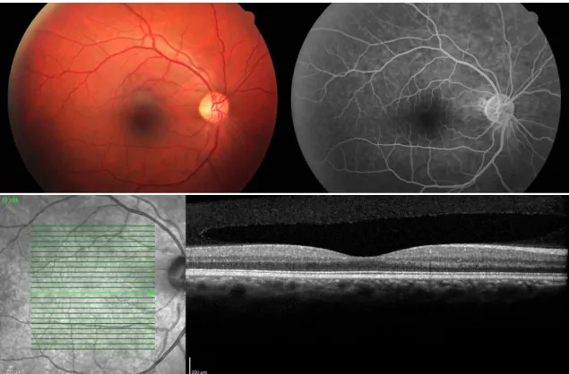 Fig. 4 – Retinografia, angiografia e tomografia de coerência ótica do olho direito à apresentação,  que não  revelaram qualquer alteração