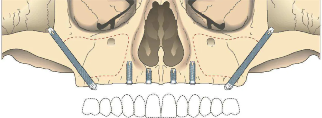Figura 3 - Posicionamento idealizado dos implantes (Branemark, 2004)
