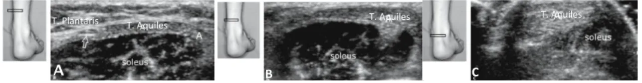 Figura 3  -  Avaliação transversal do tendão de Aquiles – posição da sonda e imagem ecográfica