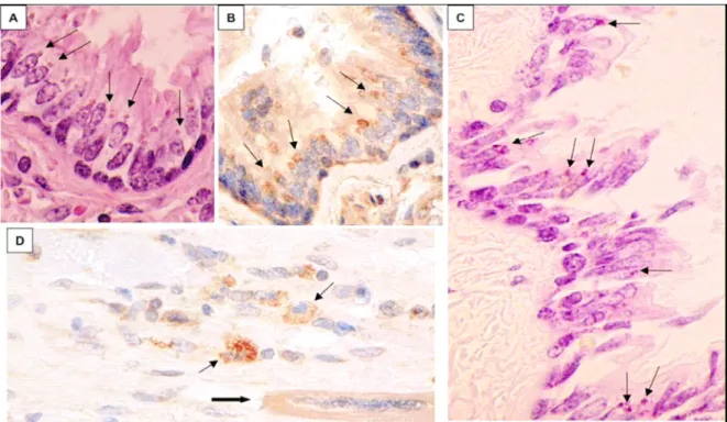 Figure  2:  Estudo  dos  tecidos  de  paciente  com  DK  à  microscopia.  A)  corte  histológico  (CH)  de  epitélio  brônquico  ciliado demonstrando  inclusões  citoplasmáticas  supranucleares