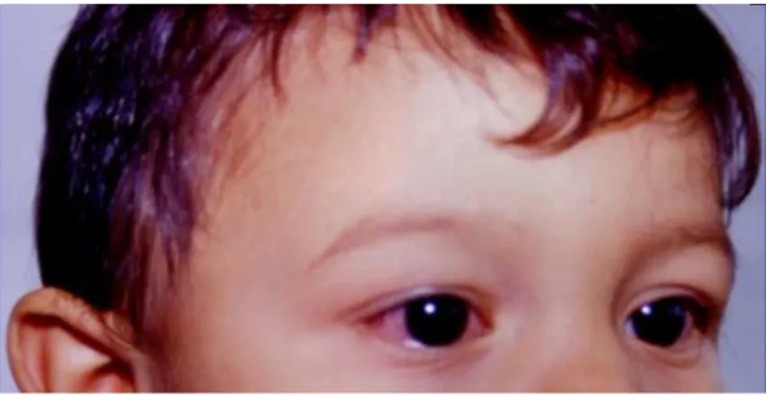 Figura 15: hiperemia  conjuntival 